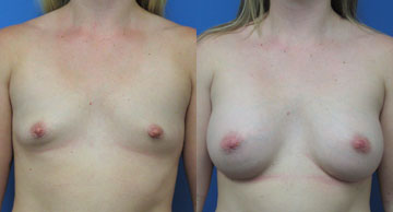 before and after Breast Augmentation photos Dr. Christine Rodgers Denver Plastic Surgery width='360