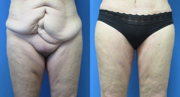 before and after Tummy Tuck two photos Dr. Christine Rodgers Denver Plastic Surgery