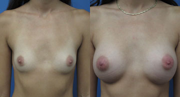 before and after photos for Breast Augmentation Dr. Christine Rodgers Denver Plastic Surgery