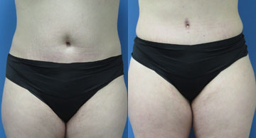 Tummy Tuck before and after photos Dr. Christine Rodgers Denver Plastic Surgery