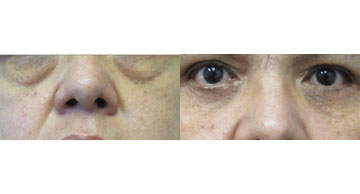 before and after photo Blepharoplasty Dr. Christine Rodgers Denver Plastic Surgery