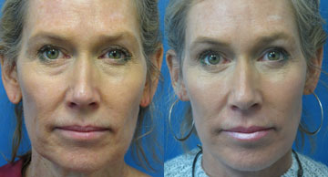 Face Lift before and after photos Dr. Christine Rodgers Denver Plastic Surgery