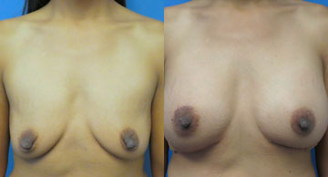 Breast Augmentation Dr. Christine Rodgers Denver Plastic Surgery before and after photos width='360