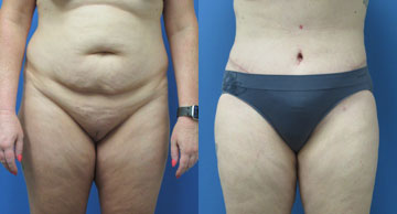 Dr. Christine Rodgers Denver Plastic Surgery before and after photos Tummy Tuck