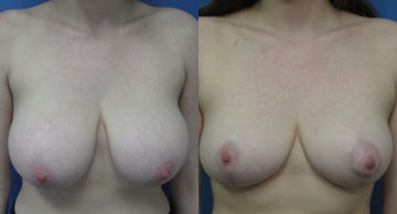 Breast Reduction before and after photos Dr. Christine Rodgers Denver Plastic Surgery