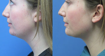 before and after photos for Submental Liposuction Dr. Christine Rodgers Denver Plastic Surgery