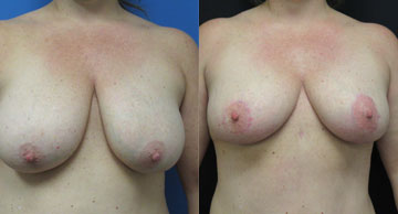 Dr. Christine Rodgers Denver Plastic Surgery before and after photos of Breast Reduction