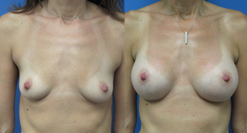 before and after photos of female breasts before and after breast augmentation Dr. Christine Rodgers Denver Plastic Surgery case 005