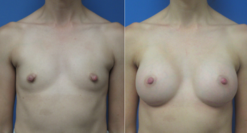 before and after photos frontal view of woman who desired larger breasts Dr. Christine Rodgers Denver Plastic Surgery width='360