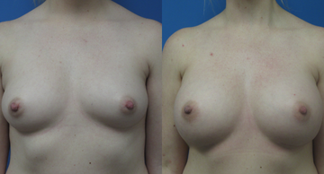 before and after photos frontal view of woman who desired breast augmentation Dr. Christine Rodgers Denver Plastic Surgery width='360