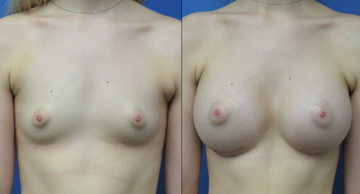 before and after frontal breast photos of woman who desired breast augmentation Dr. Christine Rodgers Denver Plastic Surgery width='360