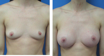 before and after photos of female breasts before and after breast augmentation Dr. Christine Rodgers Denver Plastic Surgery case 16