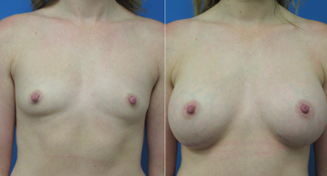 before and after photos of female breasts before and after breast augmentation Dr. Christine Rodgers Denver Plastic Surgery case 17