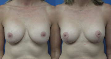 before and after photos of female breasts before and after breast augmentation Dr. Christine Rodgers Denver Plastic Surgery case 001 width='360