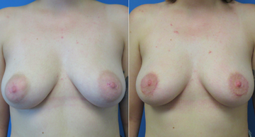 before and after photos of female breasts before and after breast augmentation Dr. Christine Rodgers Denver Plastic Surgery