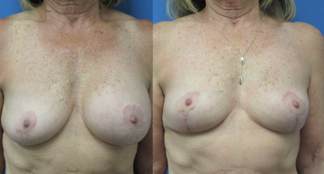 before and after photos frontal view of woman who desired breast augmentation Dr. Christine Rodgers Denver Plastic Surgery