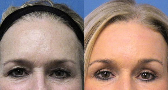 Blepharoplasty / Brow Lift Case 006 width='580