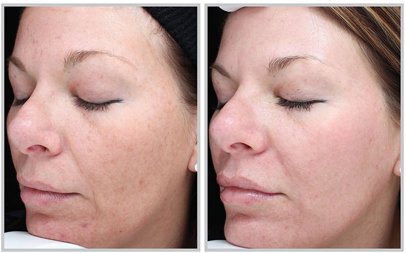 Halo Fractional Laser